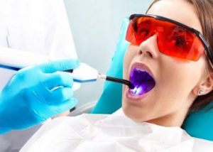 Tooth Colored Dental Fillings