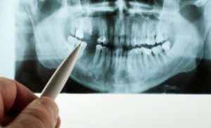dental implants mound mn