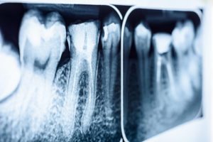 Root Canal Dentists In Chaska, MN