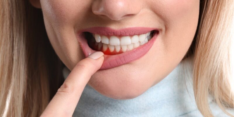 is extraction necessary for periodontitis