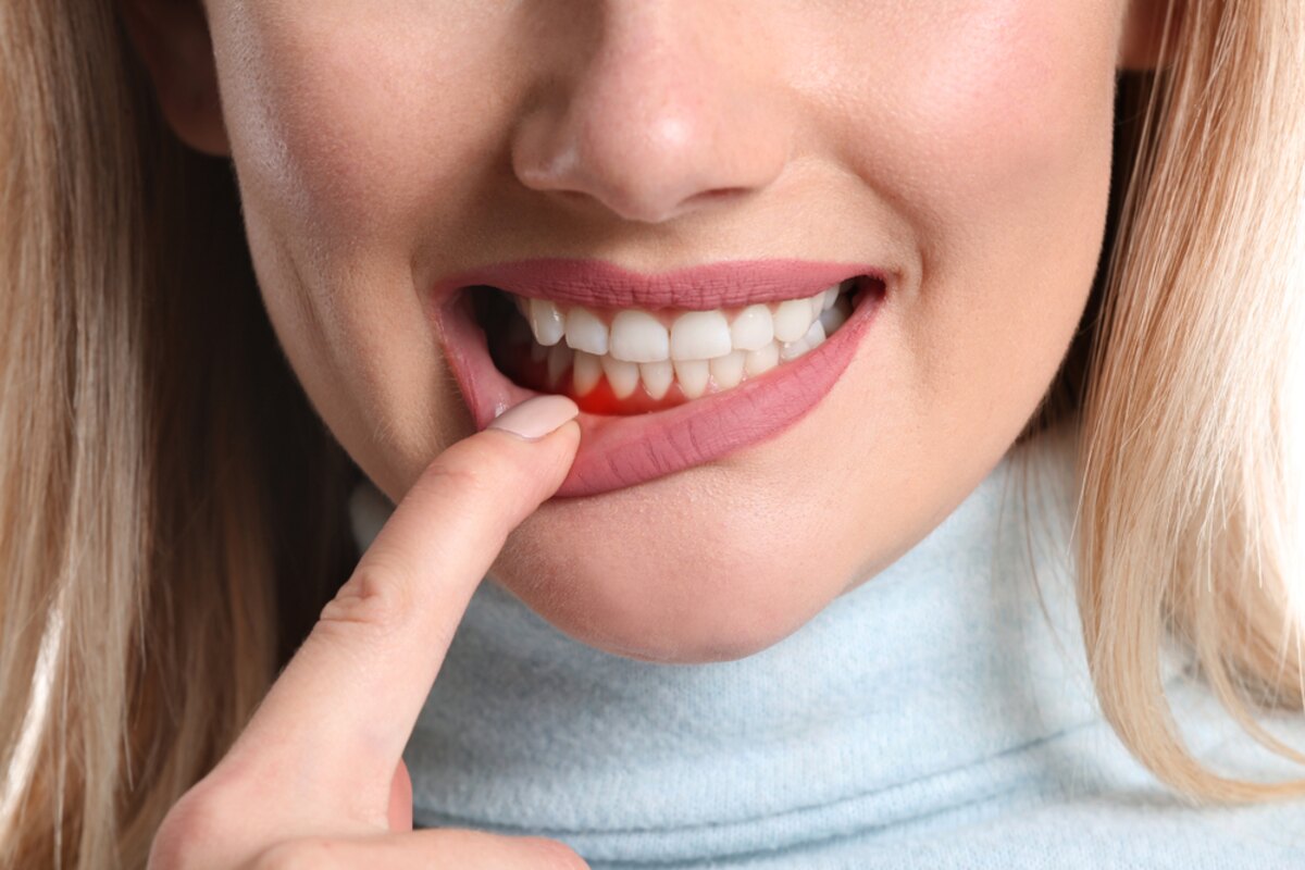 is extraction necessary for periodontitis