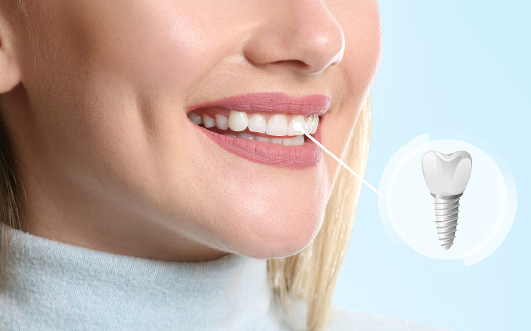 a simple look at the history of dental implants