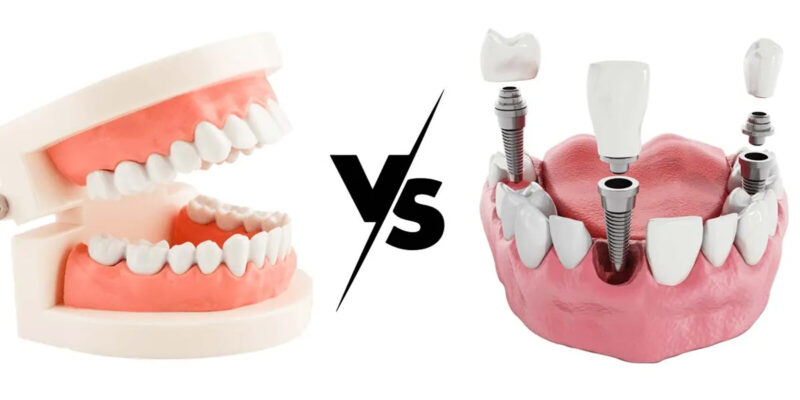 dentures vs implants why dental implants are a smart choice