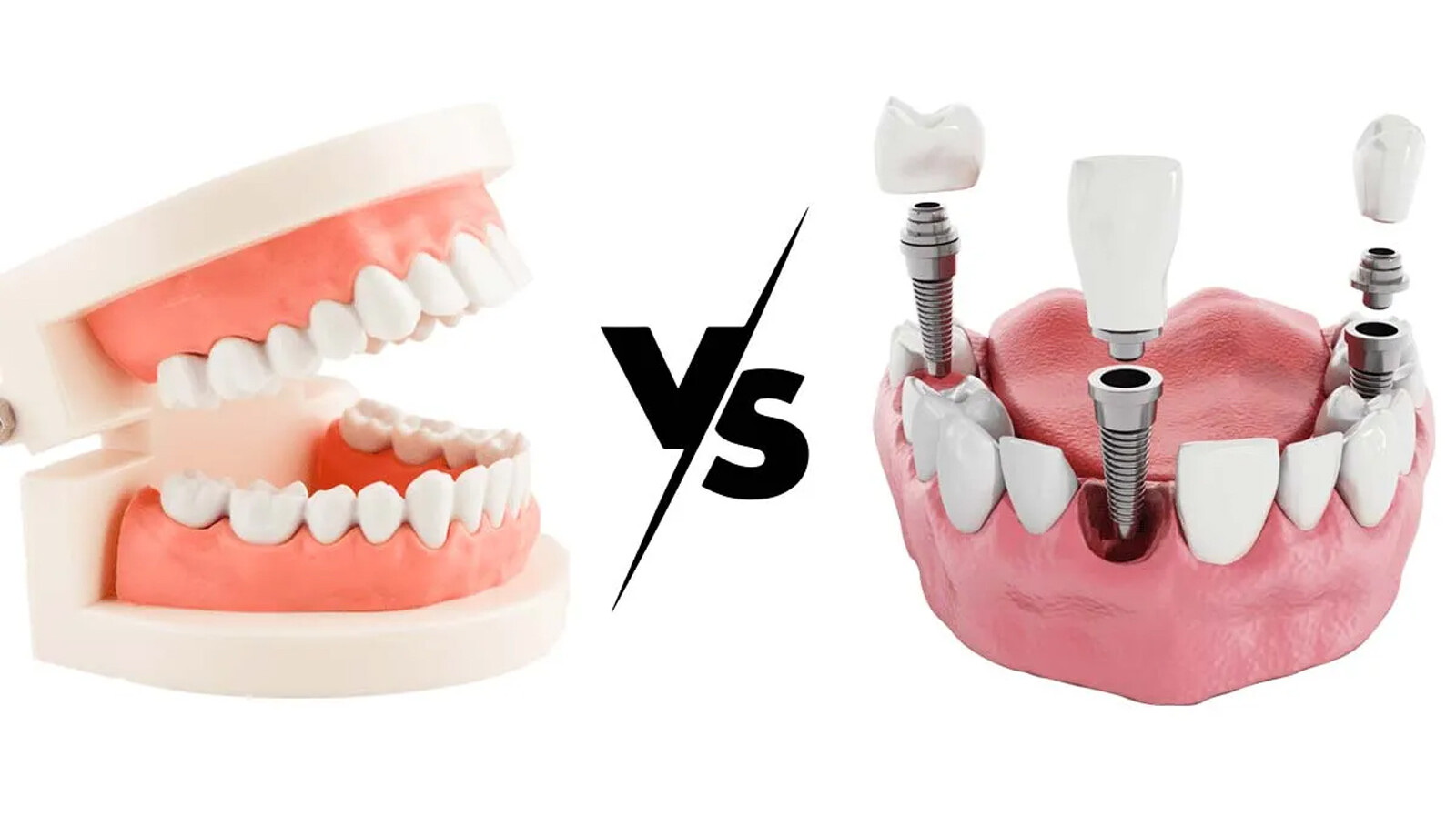 dentures vs implants why dental implants are a smart choice