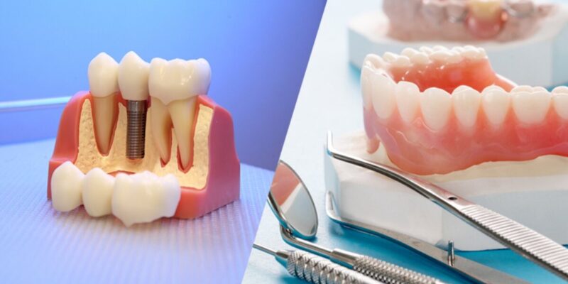 dental implants vs dentures what’s best for you in chaska and mound