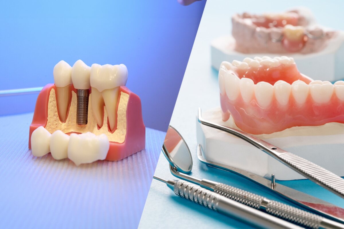 dental implants vs dentures what’s best for you in chaska and mound